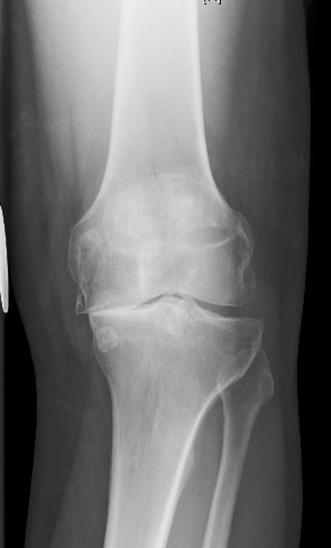 Artrosis de Rodilla - Orthotrauma Perú